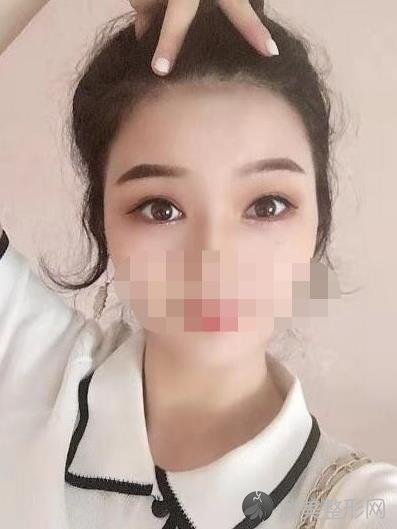 北京美莱医疗美容医院刘晓荣医生全切双眼皮术后5个月