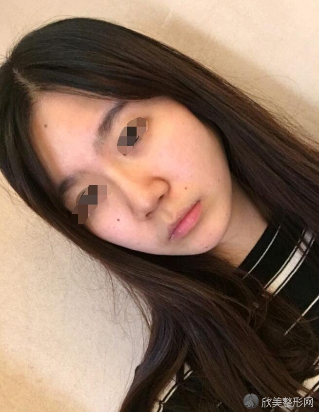 <a href='https://www.joshreso.com/project/673.html' target='_blank'><u>瘦脸针</u></a>术前