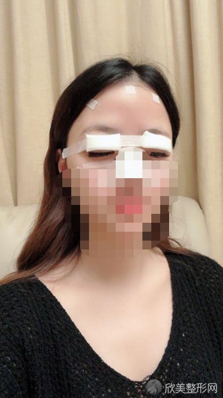 西安西京医院整形科宋保强医生做双眼皮过程