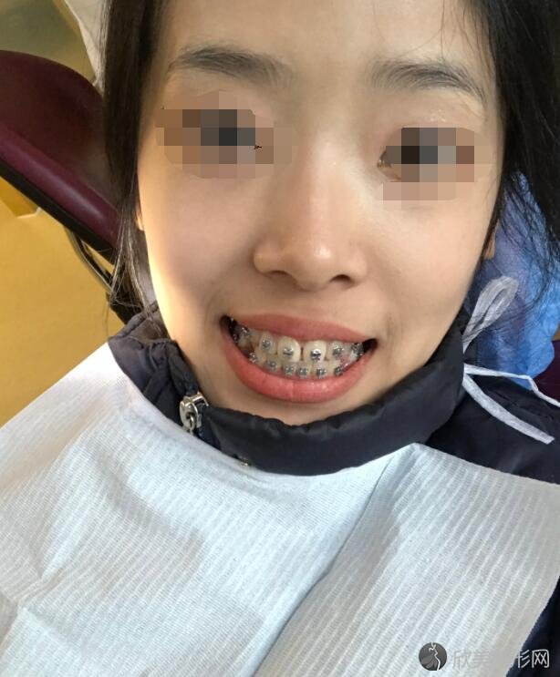 牙齿矫正术后20天