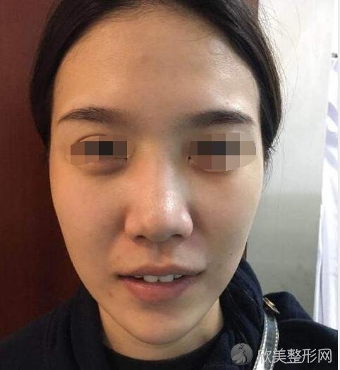 <a href='https://www.joshreso.com/mianbuzx/' target='_blank'><u>面部填充</u></a>术前