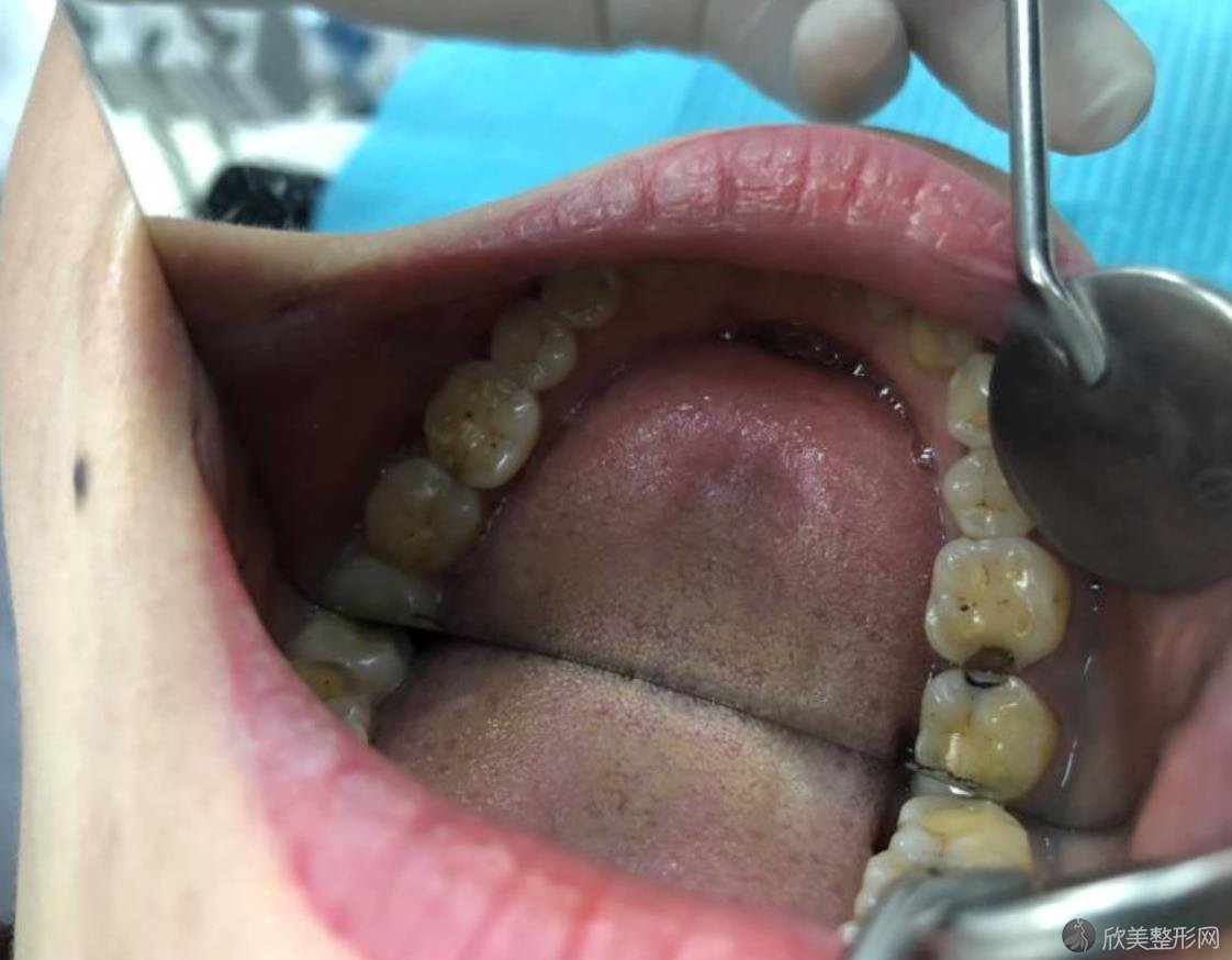 重庆美奥口腔黄泽源医生牙齿缺失补全手术