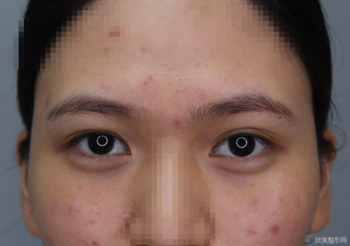 郑州禾丽整形医院双眼皮之前
