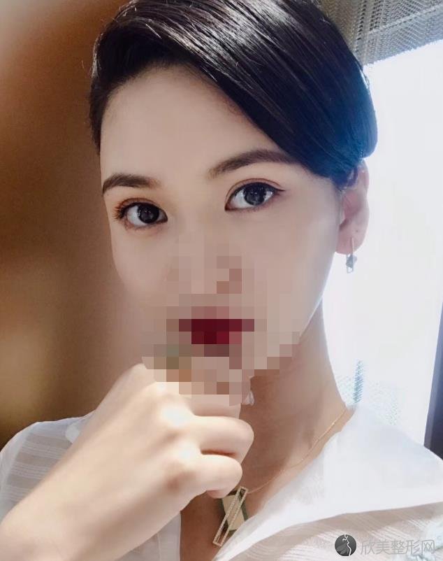 郑州禾丽整形医院双眼皮之后