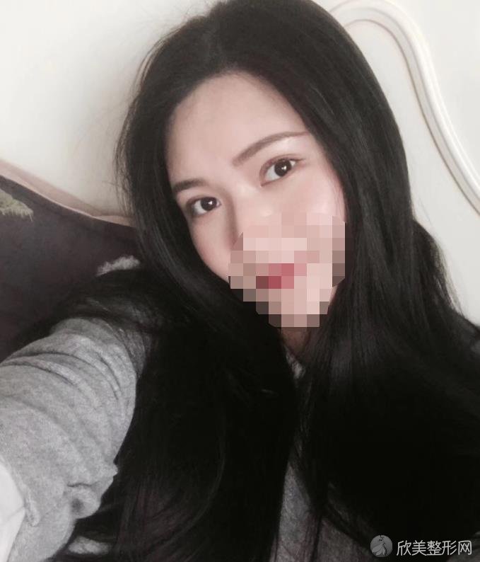 郑州禾丽整形医院双眼皮之后