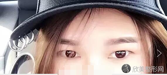 双眼皮术前