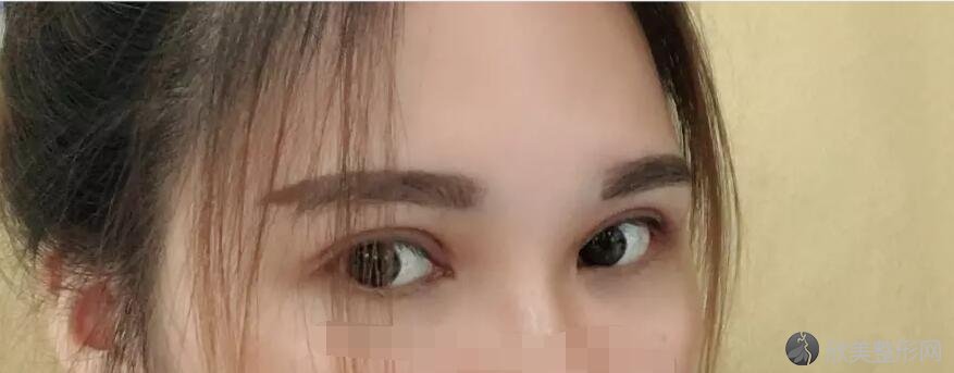 双眼皮说30天