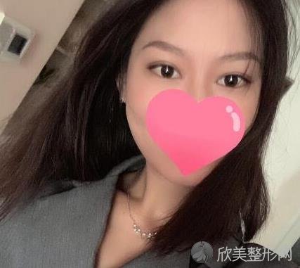 郑大二附院美容科口碑好不好？在此医院做双眼皮效果好不好