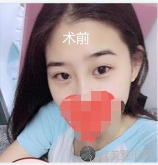 双眼皮术前
