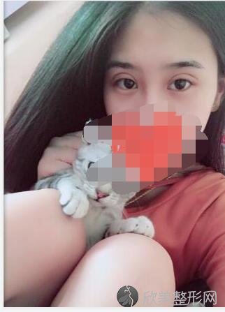 双眼皮术后20天