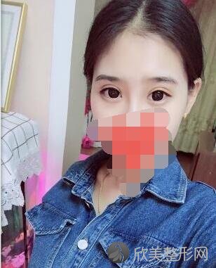 双眼皮术后30天