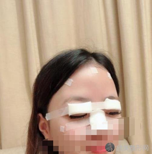 北京八大处整形美容医院杨晓宁医生做双眼皮恢复期