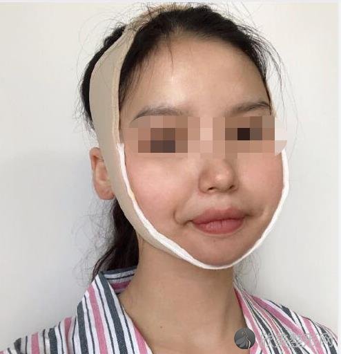北京八大处整形美容医院杨斌医生做下颌角恢复期