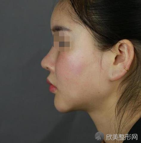 北京八大处整形美容医院尹琳医生做下颌角之前