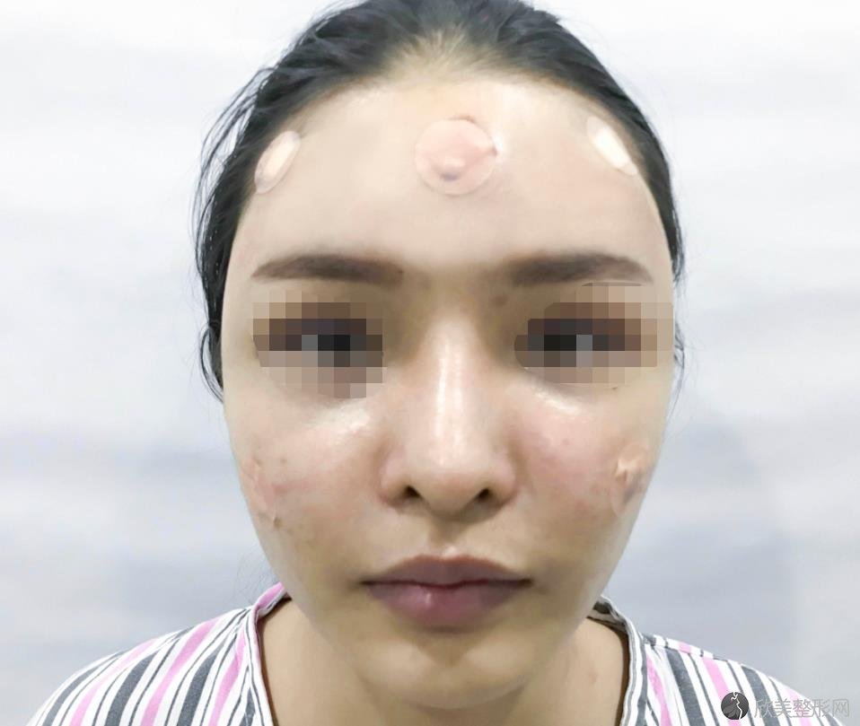 北京八大处张心瑜医生做面部填充技术好不好？来看实际效果