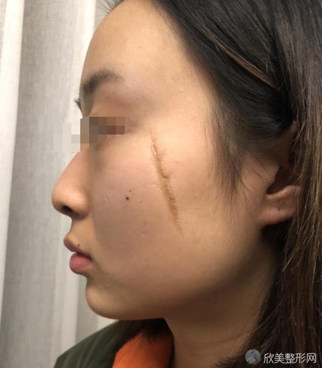 上海九院整形美容外科杨军医生做去疤痕手术效果还是不错的~来看详细介绍