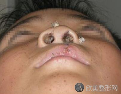上海九院整形美容外科朱昌医生唇腭裂修复手术