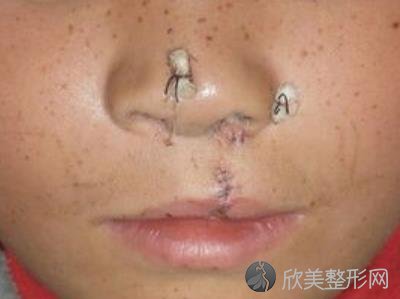 上海九院整形美容外科朱昌医生唇腭裂修复手术之后