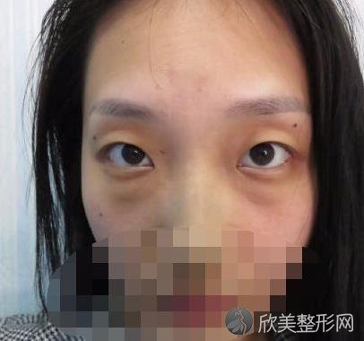 上海九院整形美容修复外科金云波医生做去眼袋之前