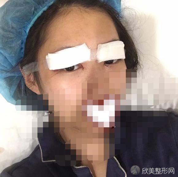 上海美莱整形美容医院吴海龙医生做双眼皮之前