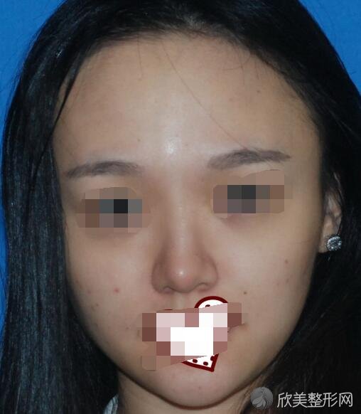 上海伊莱美整形医院靠谱吗 王瑾医生做隆鼻技术怎么样 欣美整形 上海伊莱美整形医院靠谱吗 王瑾医生做隆鼻技术怎么样 欣美整形