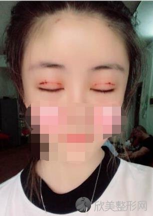 北京八大处整形美容医院李秋月医生做双眼皮之前