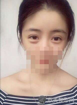 北京八大处整形美容医院李秋月医生做双眼皮之后
