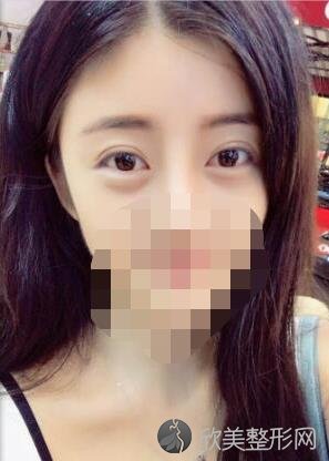 北京八大处整形美容医院李秋月医生做双眼皮之后