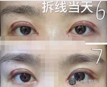北京东方百合整形美容医院王世勇医生开眼角之后