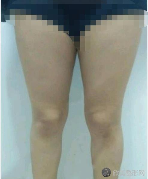 北京东方和谐整形美容医院王自谦医生做大腿吸脂之前