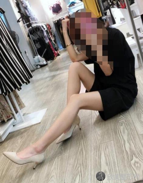 北京东方和谐整形美容医院王自谦医生做大腿吸脂之后