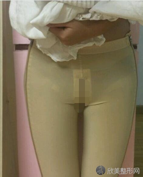 大腿吸脂术后3天