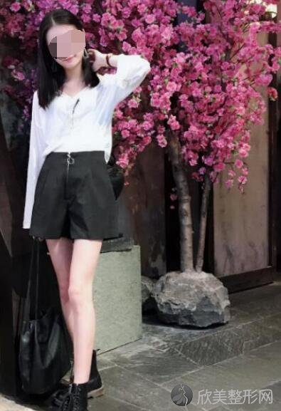 大腿吸脂术后30天