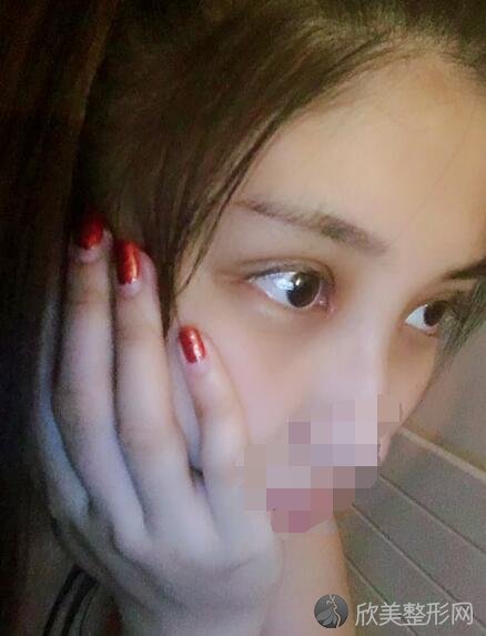双眼皮术后20天