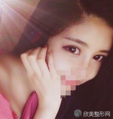 双眼皮术后30天