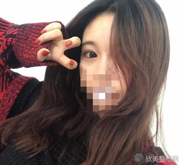 双眼皮术后20天
