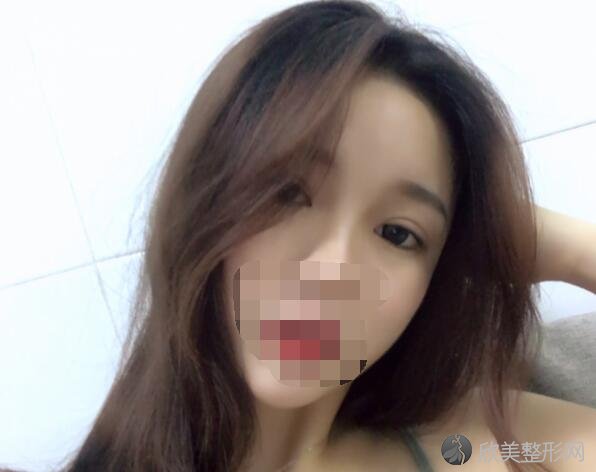 双眼皮术后30天