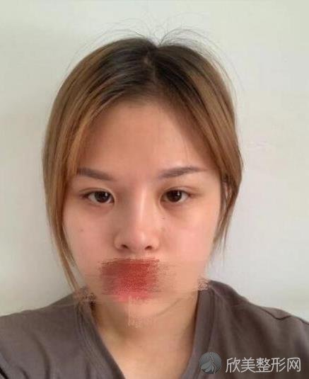 上海清沁整形美容医院孙沣医生双眼皮之前