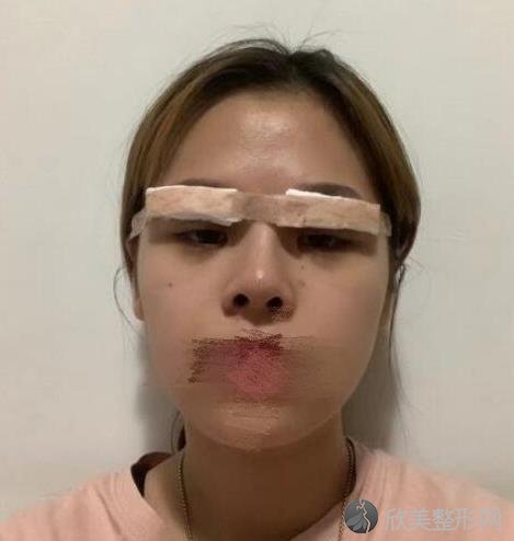 上海清沁整形美容医院孙沣医生双眼皮之后