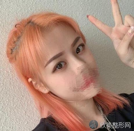 上海清沁整形美容医院孙沣医生双眼皮之后