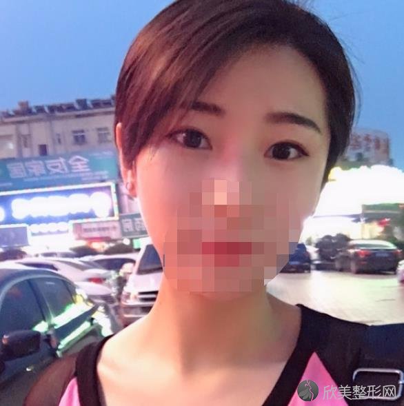 上海容妍医疗美容医院柴云医生双眼皮之前