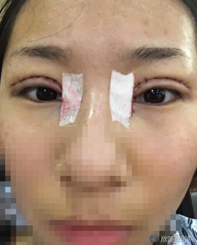 上海容妍医疗美容医院柴云医生双眼皮之后