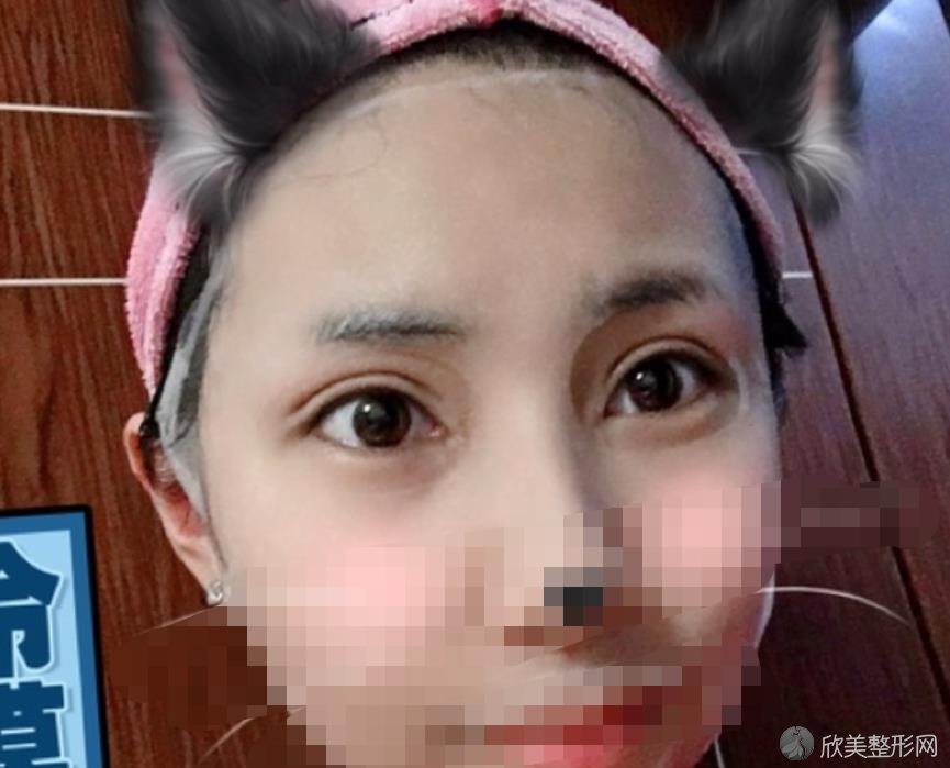上海容妍医疗美容医院柴云医生双眼皮之后