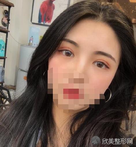 上海容妍柴云眼综合怎么样？柴云简介-双眼皮价目表