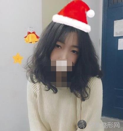 上海生命树整形美容医院王衡健医生做双眼皮之前