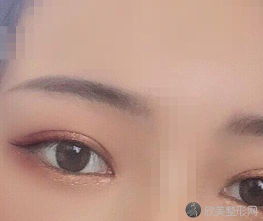 上海生命树整形美容医院王衡健医生做双眼皮之后