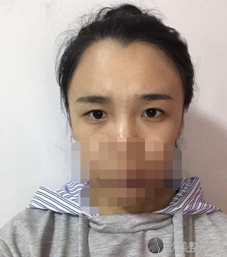 上海薇琳整形美容医院张怀军医生做双眼皮之前