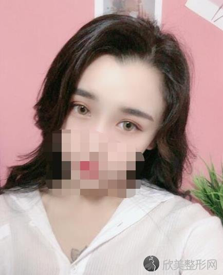 上海薇琳整形美容医院张怀军医生做双眼皮之后