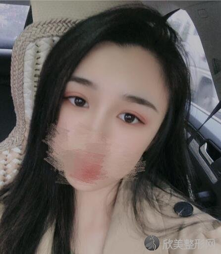 上海薇琳整形美容医院张怀军医生做双眼皮之后