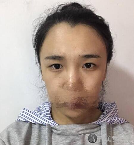 双眼皮术前